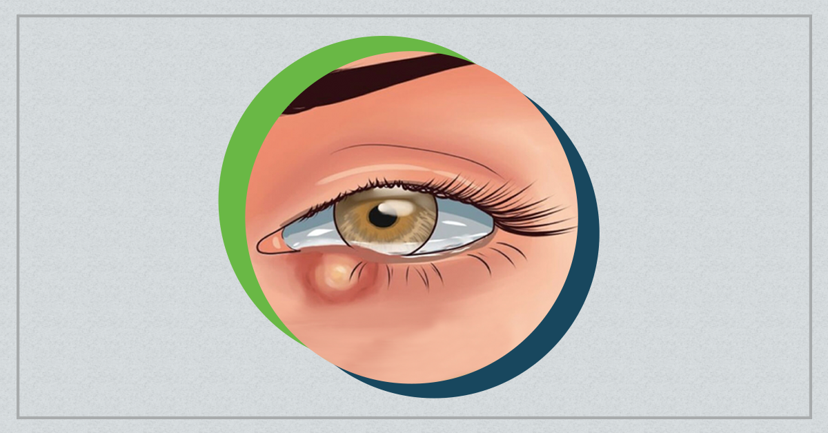 Calázio e hordéolo: o que é e como tratar